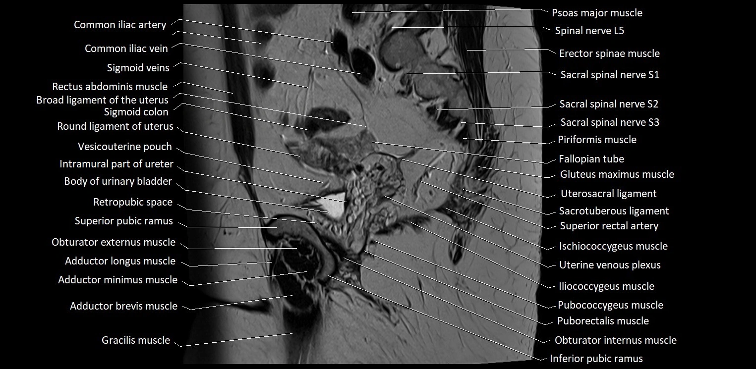 Sagittal cross sectional anatomy of female pelvis (MRI 3T) image 29.webp
